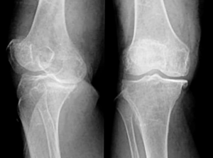 Artrose - behandeling van pijn (Presentatie)