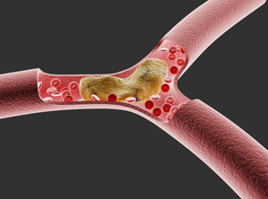 Hypercholestérolémie en prévention primaire (Présentation)